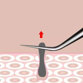 1 шт., пинцет с зажимом для черных точек, косметический инструмент, ультратонкие клеточные прыщи, игла от прыщей, очищающий пинцет из нержавеющей стали as the picture