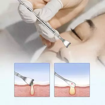 2 в 1 Инструмент для удаления прыщей, игла для удаления угрей, лечение акне, удаление белых угрей, удаление прыщей на носу и лице серебряный