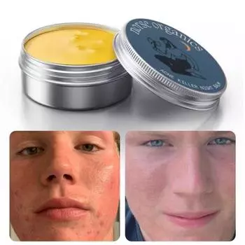30 г увлажняющий крем для восстановления кожи для мужчин и женщин, лечение угрей, комедонов, заживление кожи, натуральное увлажнение, удаление угрей, уход за кожей лица, бальзам 1pc