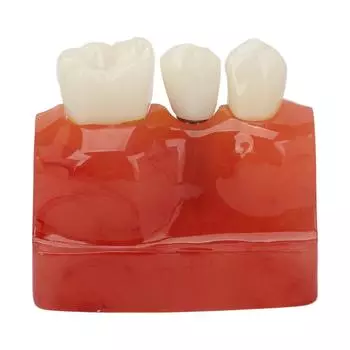 4 Times Dental Implant Model Crown Bridge Implant Teeth Demonstration Model for Doctors Patient