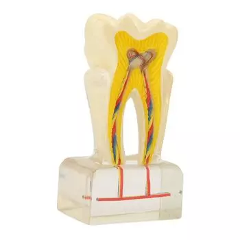 Dental Caries Model Acrylic 6 Times Decayed Tooth Model Dental Education Supplies for Dentists