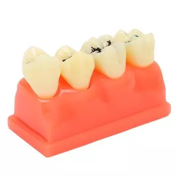 Dental Caries Model Resin 4 Teeth Oral Care Educational Decayed Tooth Display Model for Dental