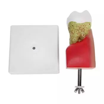 Dental Caries Tooth Model Dental Teeth Model for Teaching Training Patient Education