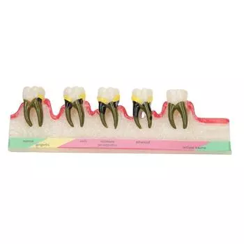Dental Periodontal Disease Model Tooth Disease Study Teaching Model for Dental School