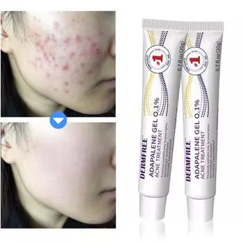 DERMFREE крем для устранения прыщей, точечный уход за проблемной кожей, следами от пор, мазь для смягчения кожного сала, 2 упаковки, 20 г