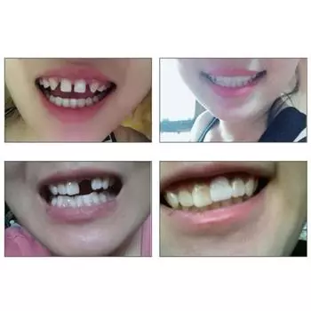 DIY временный материал для пломбирования зубов 3/10/20 мл, стоматологический инструмент для ремонта отсутствующих зубов 3ml