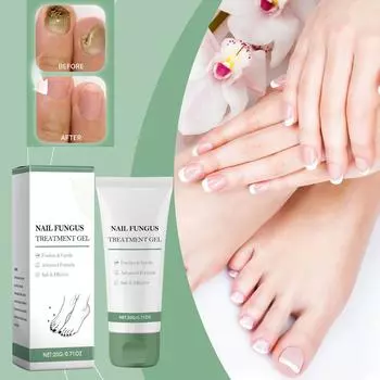 Гель-раствор для лечения онихомикоза, мягкий лак для ногтей, специальная мазь для лечения гранулемы вросшего ногтя. белый