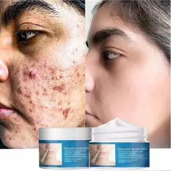Гликолевая кислота + 30% удаление прыщей, хлопковые таблетки, контроль масла, сужение пор, увлажнение и увлажнение лица, очистка и восстановление закрытых прыщей. 5g