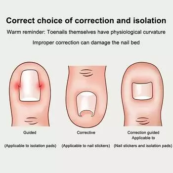 Инструмент для коррекции вросшего ногтя Эластичный пластырь для лечения вросшего ногтя Наклейка для выпрямления Зажим для скоб Инструмент для педикюра 10Set