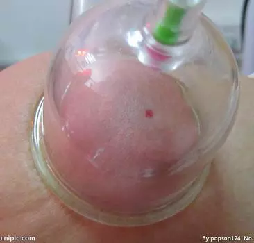 Изогнутые вакуумные чашки C1*3 для всасывания суставов, китайский массаж, традиционный