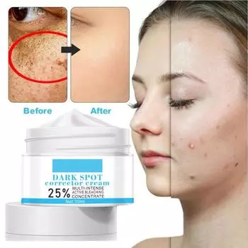 Эффективный отбеливающий крем от веснушек, удаление мелазмы, акне, темный 30 мл, уход за пигментными пятнами, кожа Moisturi Y4M1 blue-30ml