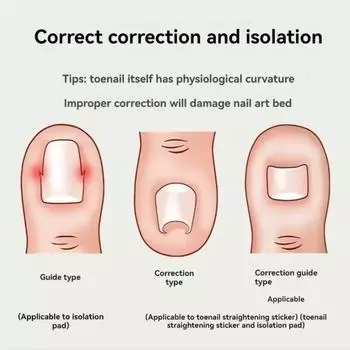 Коррекция вросшего ногтя, наполнитель в форме С, пластырь-разделитель, положительный ноготь, накладка для вросшего ногтя, корректор вросшего ногтя, инструмент для педикюра чёрный