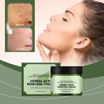 Крем для лица от прыщей, для лица и точек прыщей, натуральные растительные ингредиенты профессионально удаляют следы от прыщей, для подростков