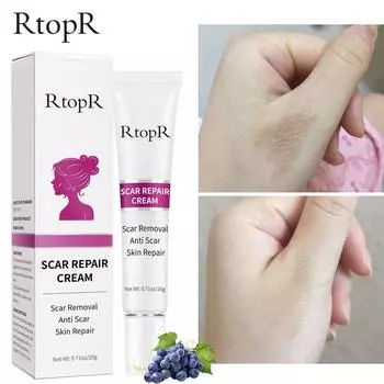 Крем для удаления шрамов от прыщей и растяжек, крем для восстановления кожи, крем для лица, гель для восстановления кожи, крем для восстановления шрамов от угрей, крем для ухода за кожей