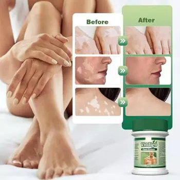 Крем для ухода за белыми пятнами, снимает симптомы кожи, устраняет пятна пота и цветочные пятна, крем для роста One Size зелёный