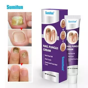 Крем для восстановления онихомикоза, 20 г. Крем для восстановления ногтей для удаления онихомикоза, питания и увлажнения ногтей.