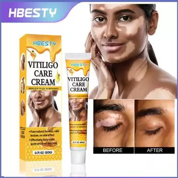 2шт HBESTY White Spot Cream, экстракт пчелиного яда для проблемных пятен, мягкий уход, массажный крем для тела