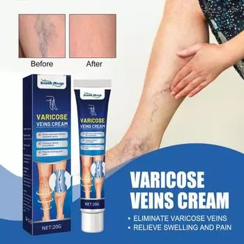 Крем, не вызывающий раздражения, натуральный экстракт, облегчение варикозного расширения вен, васкулит, флебит, боль в паутине 20g
