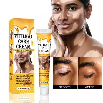 Крем от витилиго, натуральное облегчение витилиго для кожи. Витилиго, крем для ухода за витилиго, уменьшение белых пятен и улучшение пигментации кожи, простота в использовании.