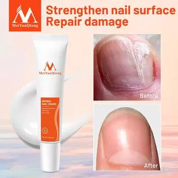 Лечение ногтей MeiYanQiong, лечение ногтей на травах, хороший результат, лечение ногтей китайскими травами на пальцах ног 1pcs