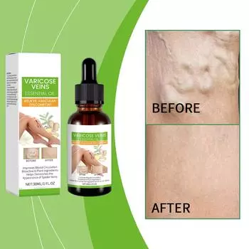 Массажное масло от варикозного расширения вен Синие вены и красные вены Массажные эссенция от варикозного расширения вен30 мл One Size