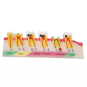 Модель развития кариеса зубов. Портативная модель пораженных кариесом зубов для обучения стоматологии.