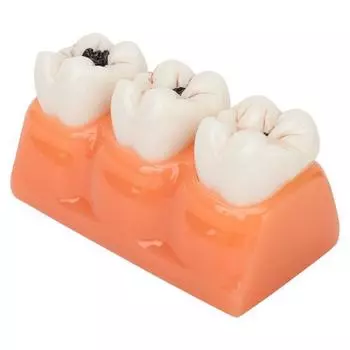Модель зубов из смолы 4 раза Патология зубов Модель пораженных кариесом зубов для обучения