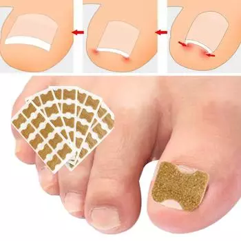 Набор для лечения вросшего ногтя. Набор корректоров и накладок для вросшего ногтя для здоровых ногтей и комфортной поддержки.