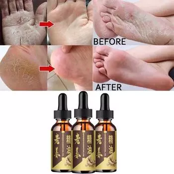 Подавление бактерий и грибков Эфирные масла Потрескавшиеся ноги Бери-бери Запах ног Зуд ног 5ml
