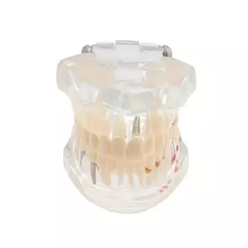 Прозрачная модель зубов с болезнями Модель зубов с имплантатами Стоматолог Студент-стоматолог Обучение, преподавание, исследование Коммуникация белый