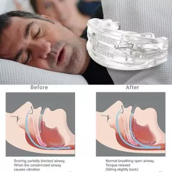 Регулировка против храпа, бруксизма, каппа, защита для зубов, апноэ во сне белый