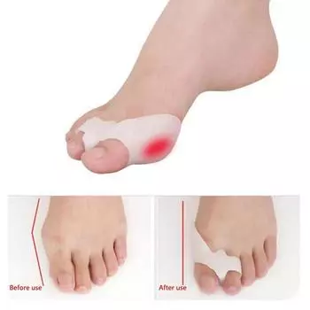 Силиконовый гель для пальцев ног, разделитель пальцев с двумя отверстиями, защита для вальгусной деформации большого пальца, защита для вальгусной деформации большого пальца стопы, перекрывающаяся подушечка для ног, 2 шт. 2pcs белый
