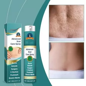 Спрей для удаления шрамов для беременных женщин, спрей для уменьшения растяжек, уход за кожей, спрей от шрамов от травм, операций, ожогов, растяжек 20 мл One Size