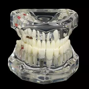 Стоматологические модели. Ремонтируемые смоляные модели больных зубов для обучения и исследований в области медицины и стоматологических заболеваний. прозрачный