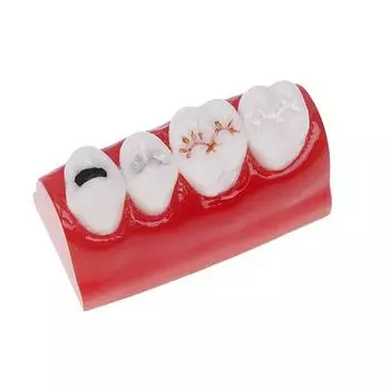 Стоматологические ресурсы Демонстрация герметиков Модель для стоматологического исследования Модель закрытой ямки и фиссуры Модель лечения зубов