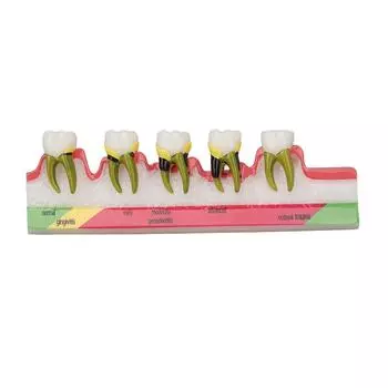 Teeth Periodontal Disease Model Different Stages Resin Dental Periodontitis Display Model