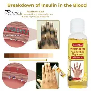 Темная кожа Масло для удаления меланина Увлажняет состояние кожи Отшелушивает кожу рук Локоть Колено Удаление омертвевшей кожи Корректор пигментов Отбеливает Украшает кожу 50ML