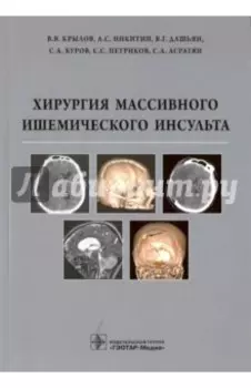 Хирургия массивного ишемического инсульта