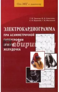 Электрокардиограмма при асимметричной гипертрофии левого желудочка