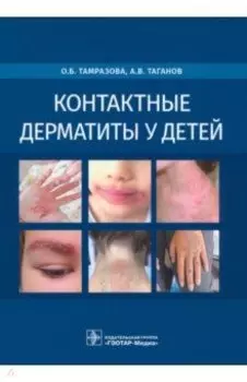 Контактные дерматиты у детей