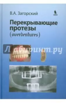 Перекрывающие протезы (overdentures)