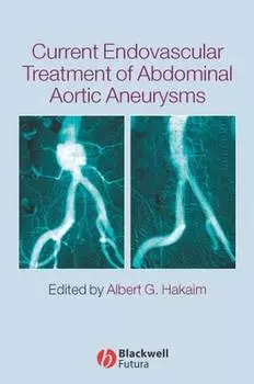 Current Endovascular Treatment of Abdominal Aortic Aneurysms