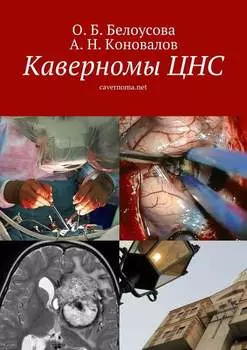 Каверномы ЦНС. cavernoma.net