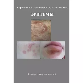 Эритемы. Руководство для врачей. Ахматова Н.К., Масюкова С.А., Сорокина Е.В.