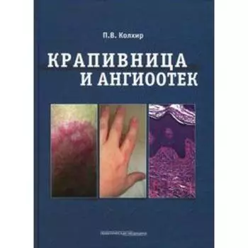 Крапивница и ангиоотек. Колхир П.В.