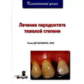 Лечение пародонтита тяжелой степени. Детенвиль Р.
