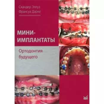 Мини-имплантаты. Ортодонтия будущего. Эллуз С.