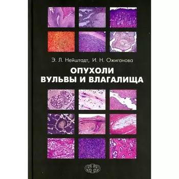 Опухоли вульвы и влагалища. Нейштадт Э.Л., Ожиганова И.Н.