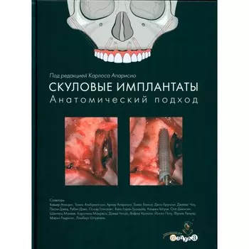 Скуловые имплантаты. Анатомический подход