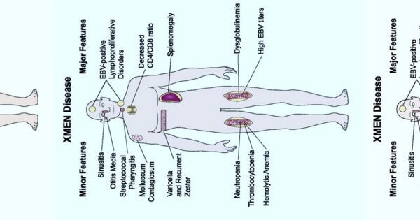 Врачи вылечили болезнь XMEN пересадкой костного мозга. Пациенту потребовалось две трансплантации стволовых клеток крови 2 Симптомы и особенности болезни X-MEN: нейтропения, анемия, высокий титр ЭБВ.